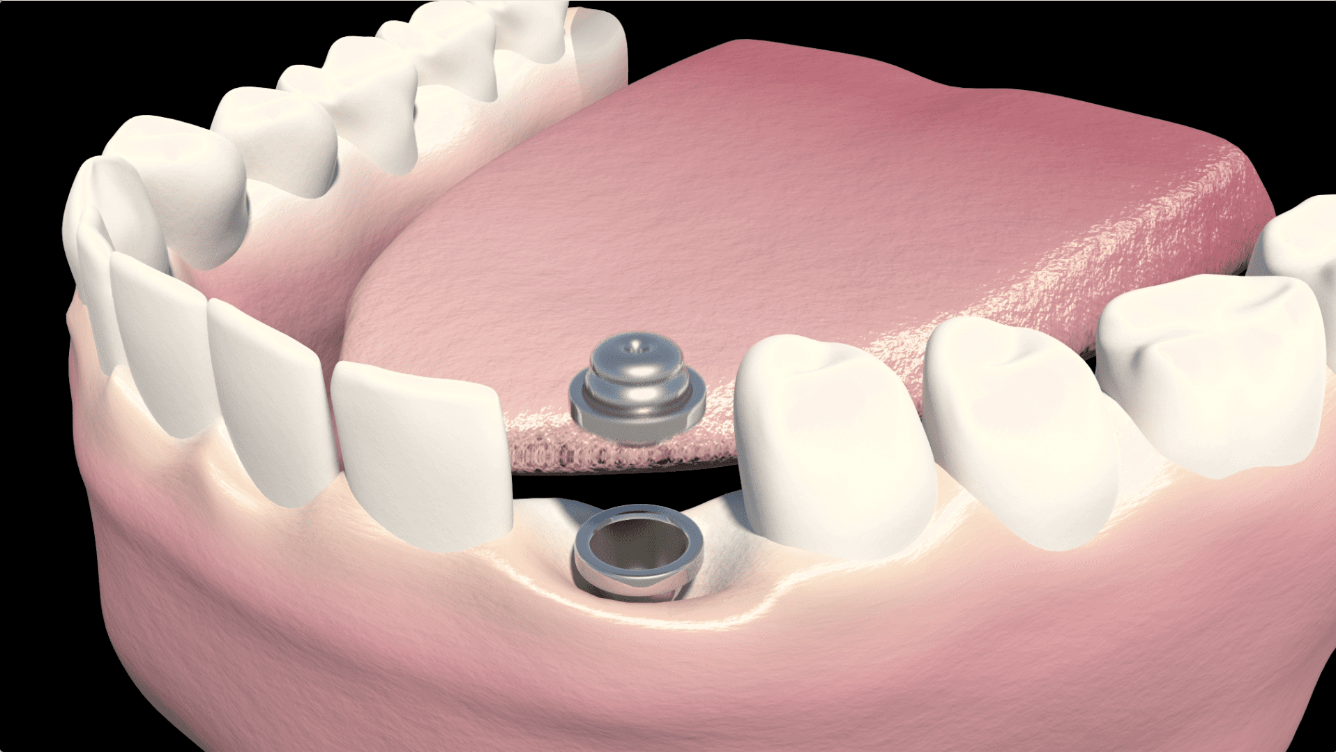 Abutment Placed on Implant