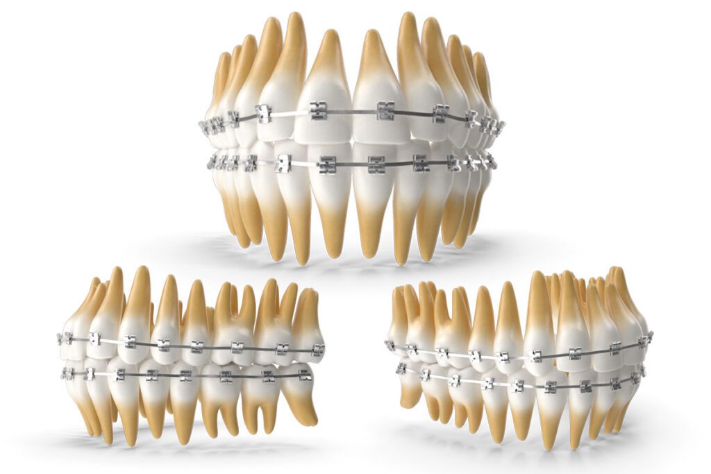 3D Braces Rendering - Golden State Dentists