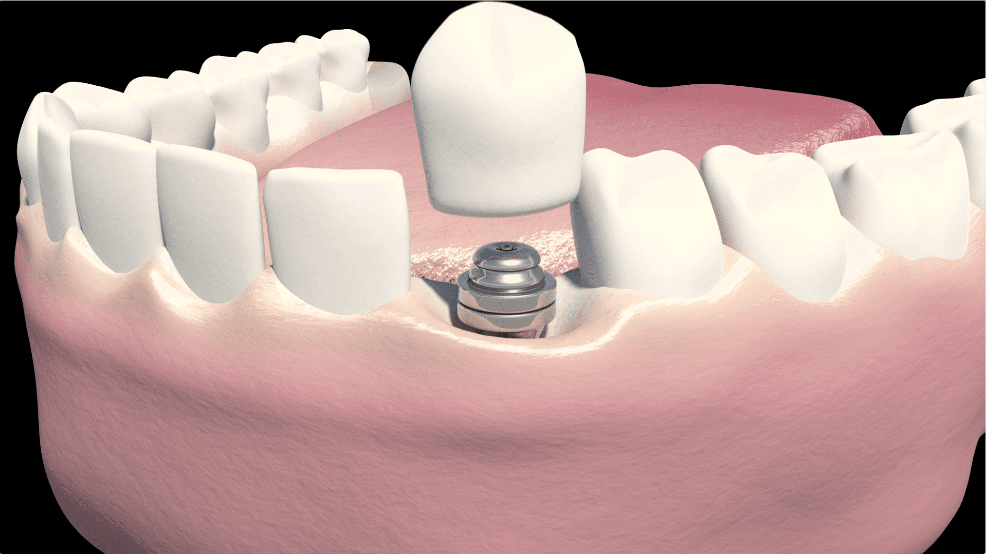 Crown attachment to implant