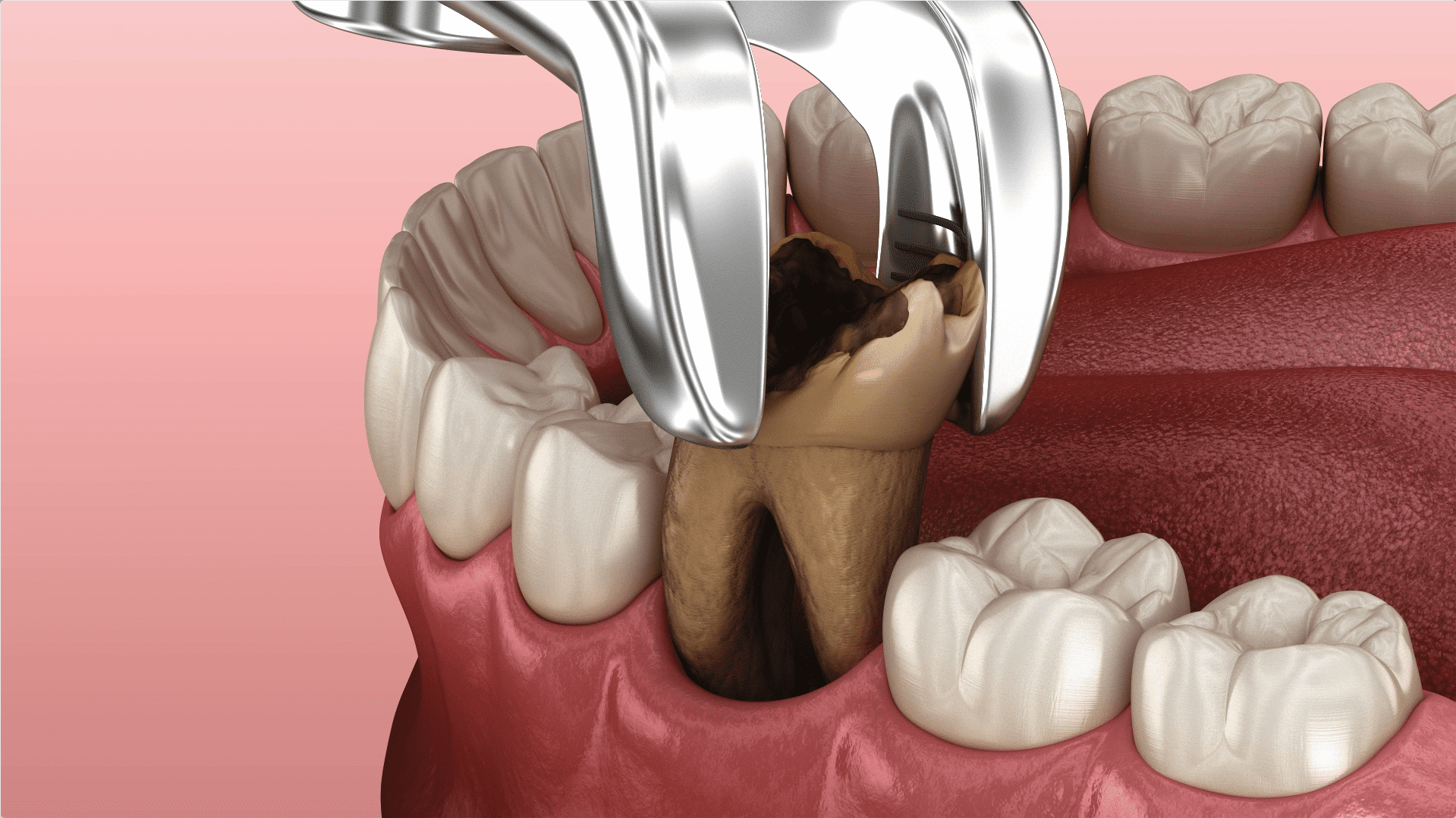 Example Tooth Removal