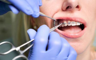 Is Orthodontics Cosmetic Dentistry? Exploring the True Purpose