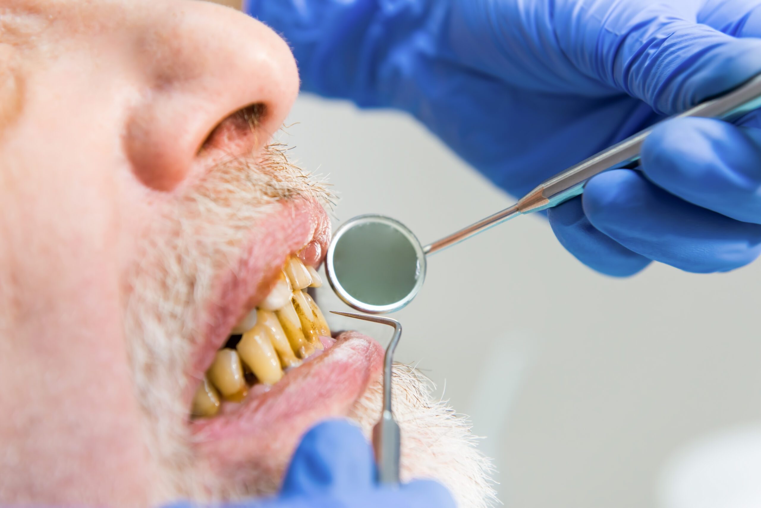 What Do Dentists Do About Yellow Teeth - Golden State Dentists