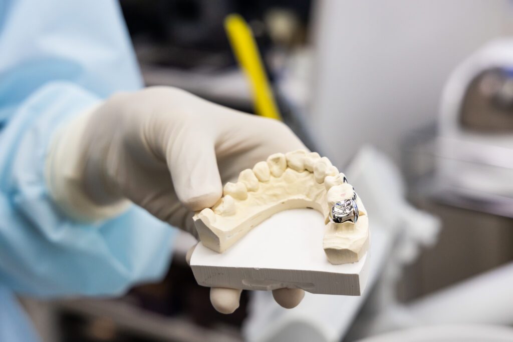 Types of Dental Crowns - Golden State Dentists